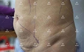 产后康复护理短视频制作 产后腹壁松弛，如何运动康复？